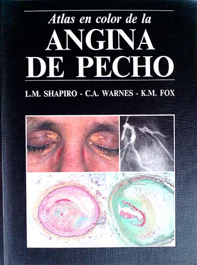 Angina de pecho
