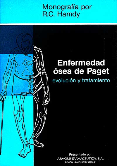 Enfermedad ósea de Paget: evolución y tratamiento