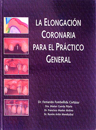 La elongación coronaria para el práctico general