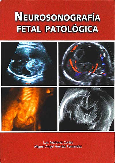 Neurosonografía fetal patológica